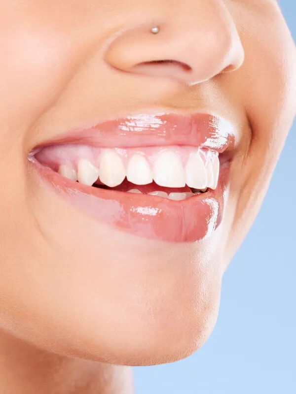 carillas dentales vitoria voltas carillas dentales vitoria voltas